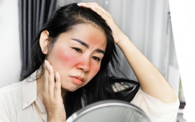 How to treat acne, rosacea and histamine sensitive skin conditions